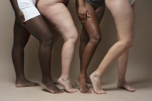 Lipedema: O que é, Como Identificar, Causas e Tratamentos