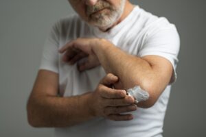 Micoses e Assaduras: Como Prevenir Problemas de Pele Comuns no Calor