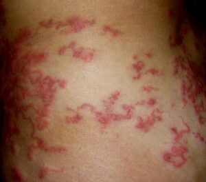Imagem de uma lesão de pele característica da Larva Migrans Cutânea (bicho geográfico), apresentando erupções avermelhadas em forma de linhas sinuosas e irregulares, típicas do parasita que migra sob a pele.