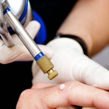 Crioterapia-tratamento-de-verrugas-1024x576