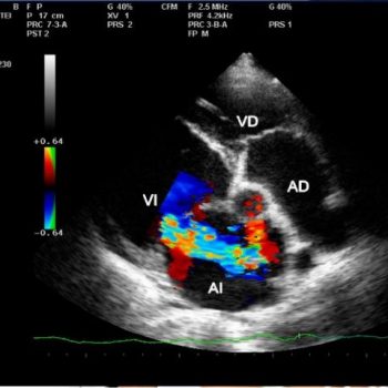 ecocardiografia-de-doppler-52734865-640x480