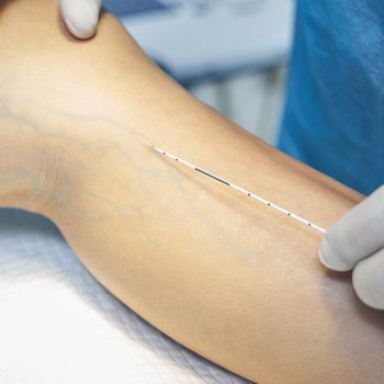 tipos-de-escleroterapia-liquida-espuma-e-a-laser